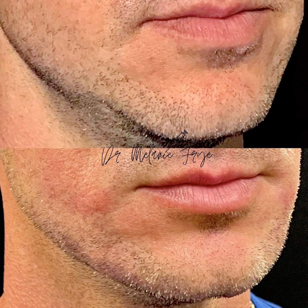 chin-fillers-before-after-a