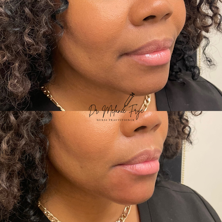 chin-fillers-before-after-b