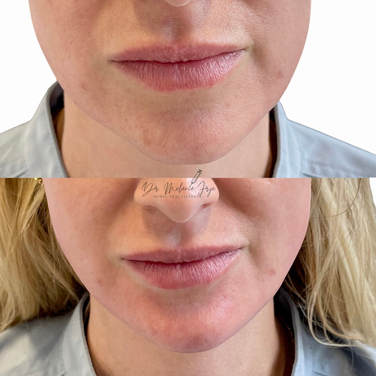 chin-fillers-before-after-c