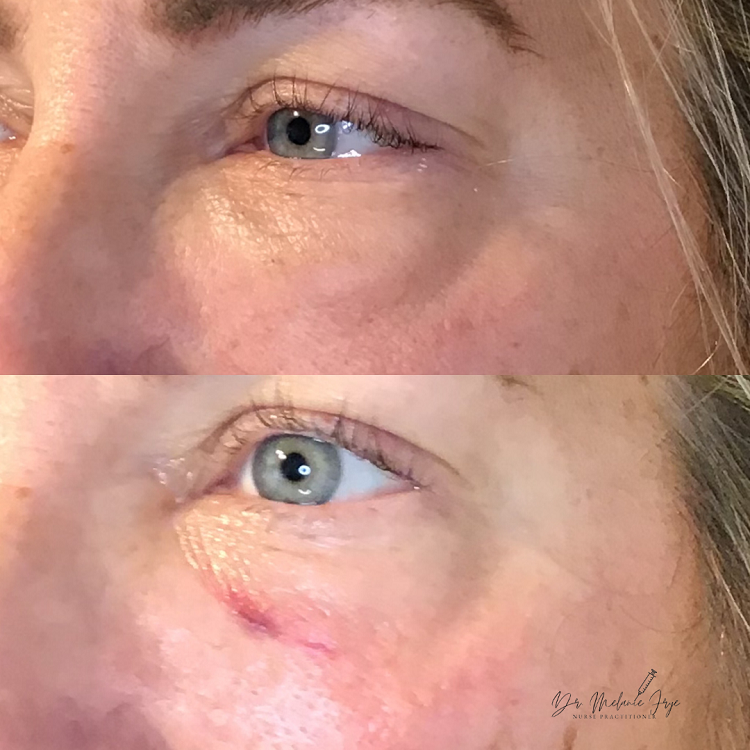 filler-rehb-before-after-a