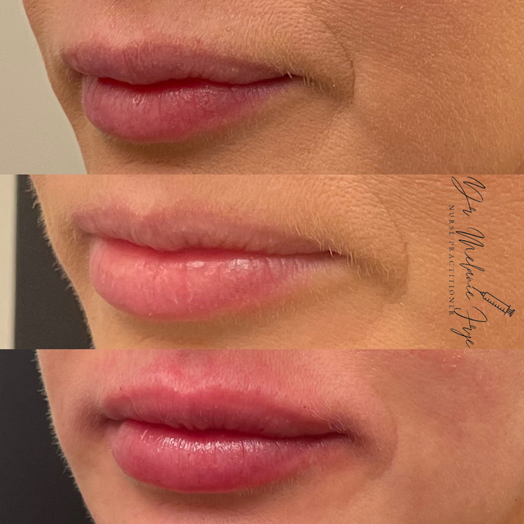 filler-rehb-before-after-b