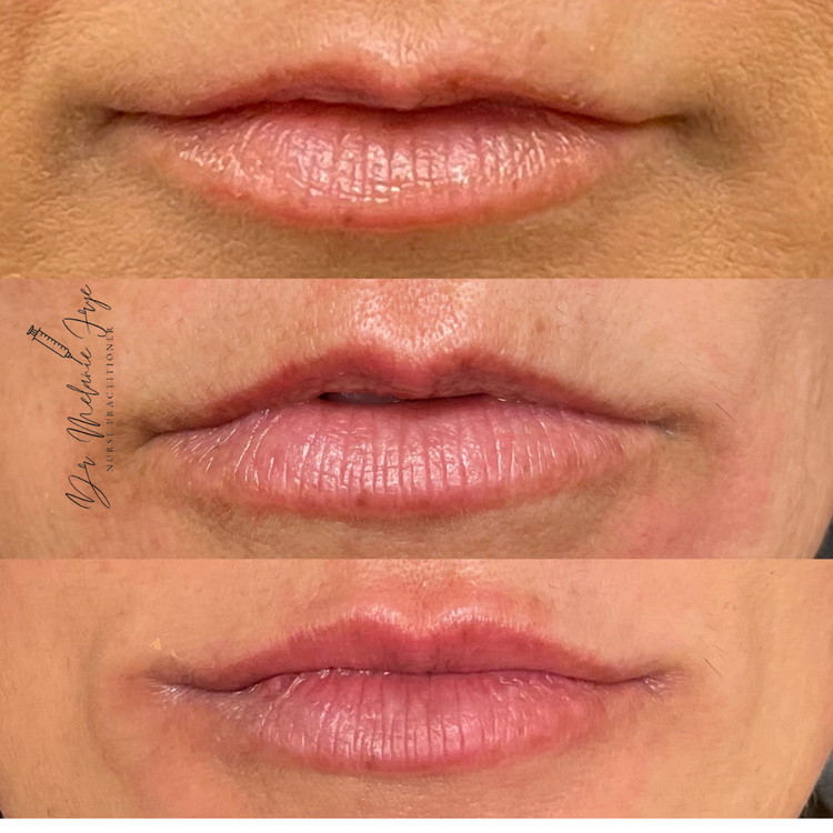 filler-rehb-before-after-c