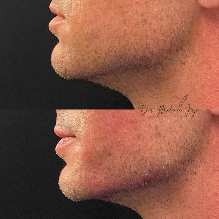 jawline-fillers-before-after-d