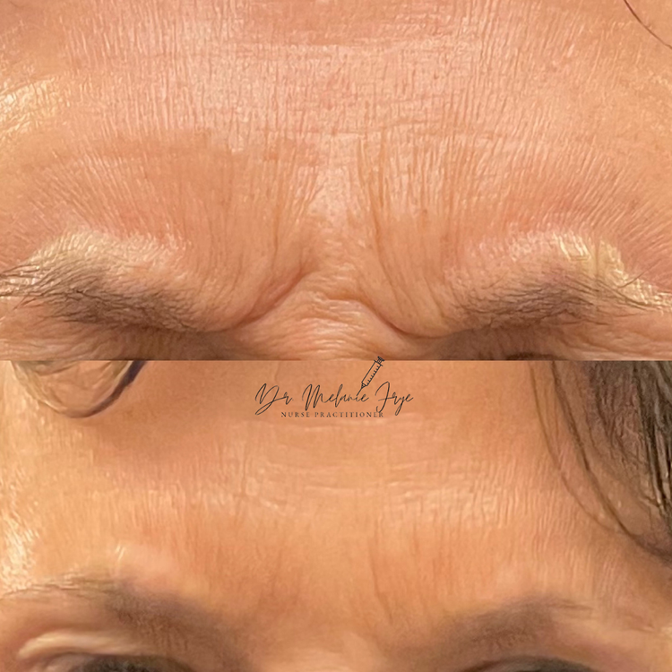 glabella-ori-aesthetics-houston-TX