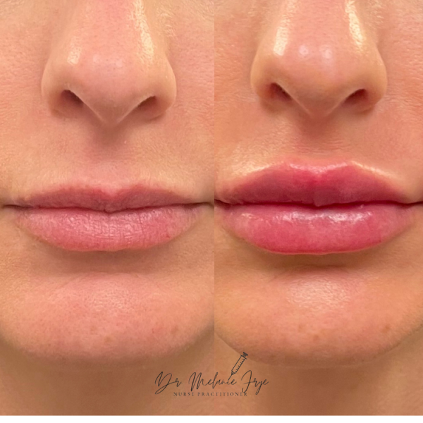 lip+filler+c