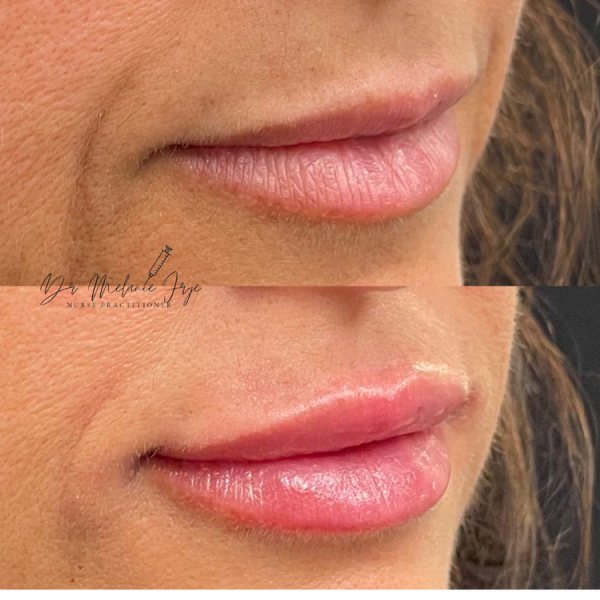 lip+filler+d