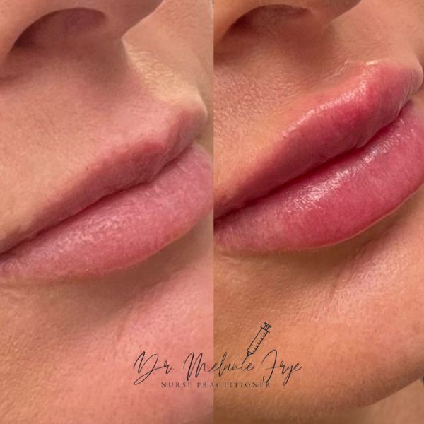 lips-filler-f