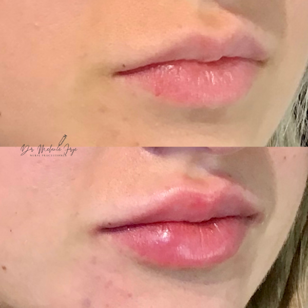 lips-filler-k