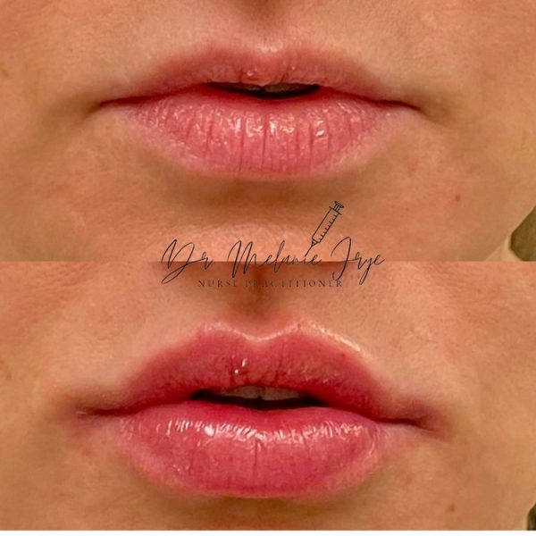 lips-fillers-g