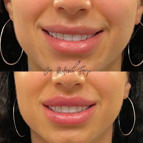 lips-fillers-i