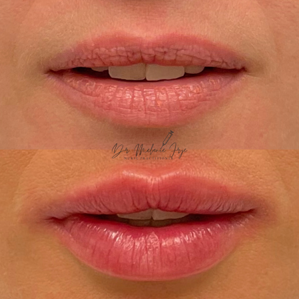 lips-fillers-j